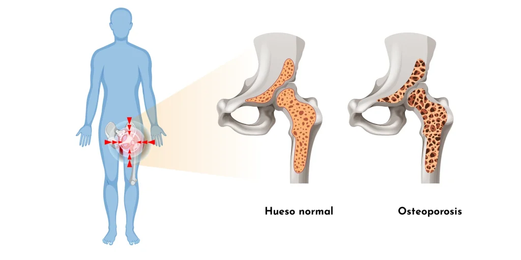 osteoporosis-grup-policlinic