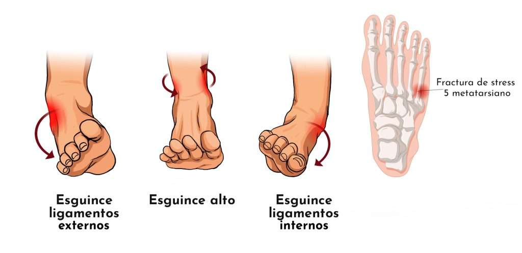10 patologies més freqüents a l’estiu a causa de l’ús excessiu de calçat inadequat
