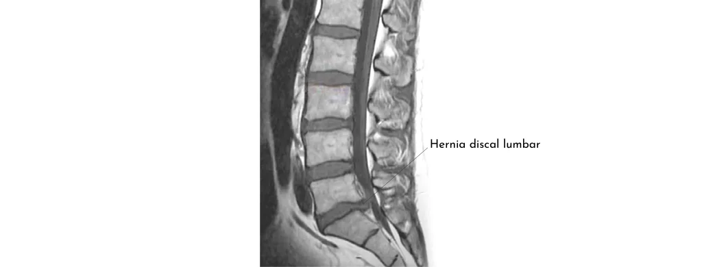 FAQ-hernia-discal-grup-policlinic
