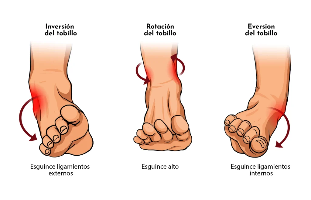 Esguince agudo de tobillo: tipos, síntomas y tratamientos
