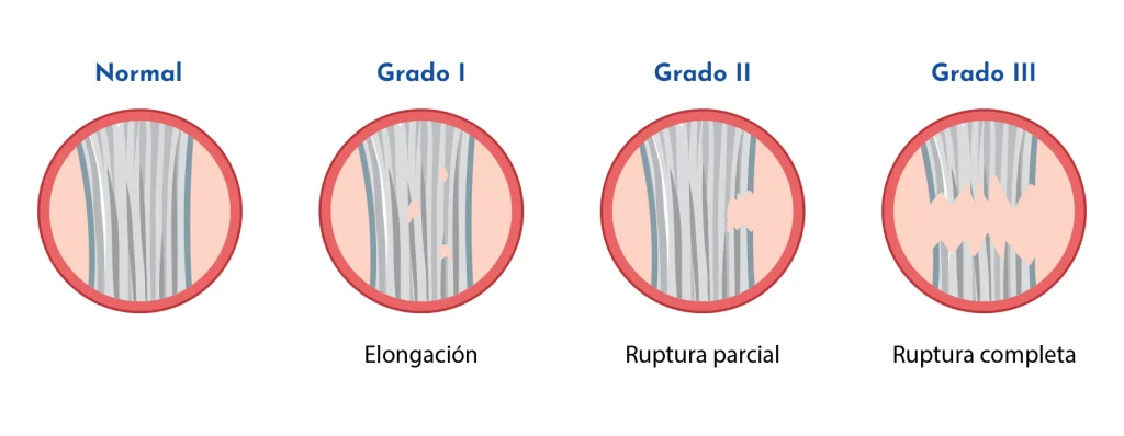 Esguince agudo de tobillo: tipos, síntomas y tratamientos