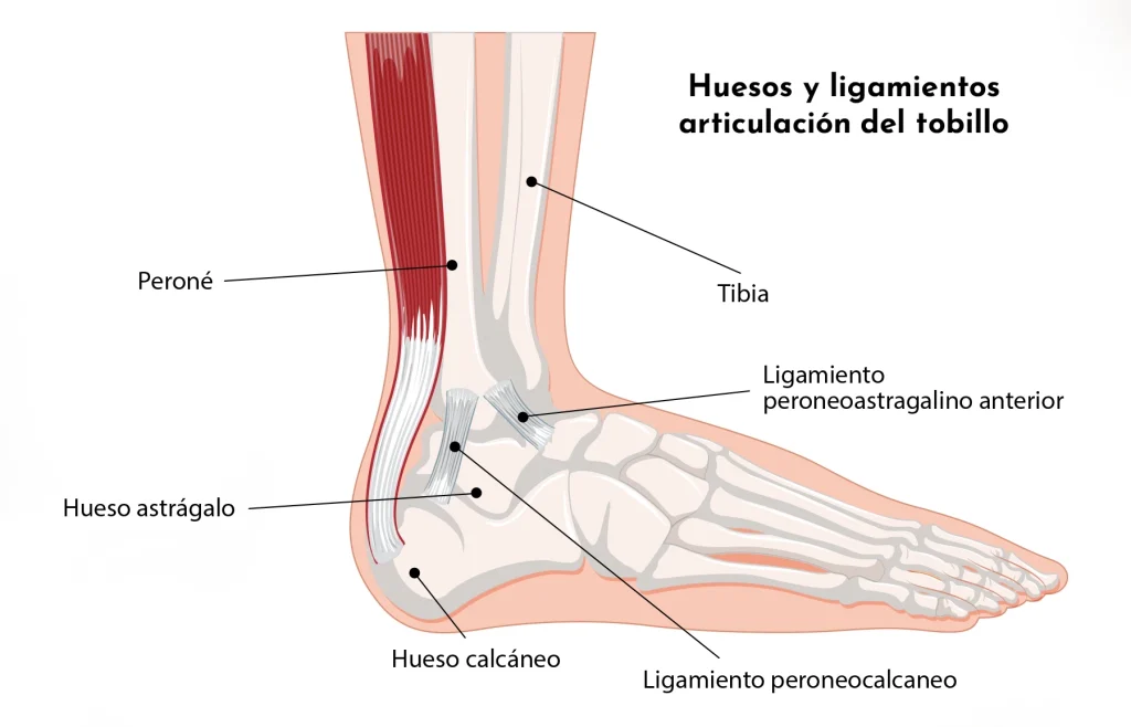Esguince agudo de tobillo: tipos, síntomas y tratamientos