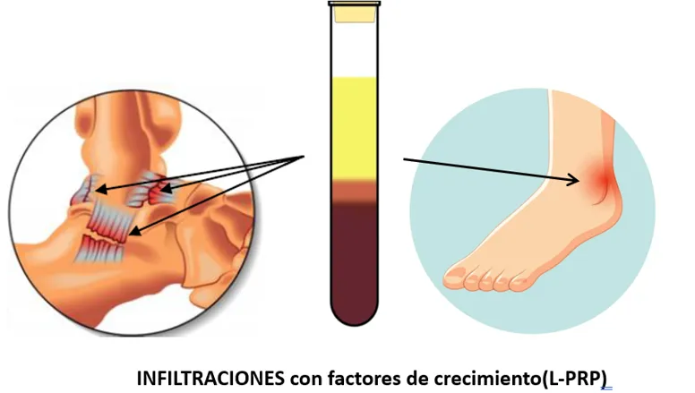 Lesión de tobillo.Tratamientos regenerativos infiltrados. Alternativas a la cirugía