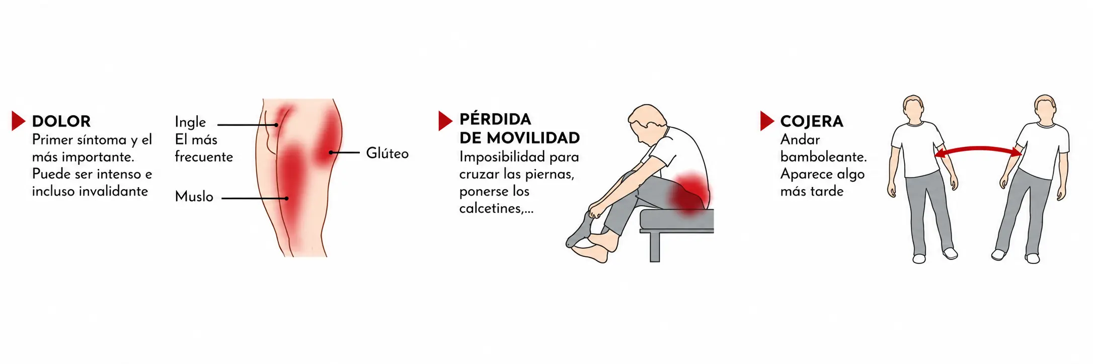 Artrosis de cadera: causas, síntomas, consejos y tratamientos