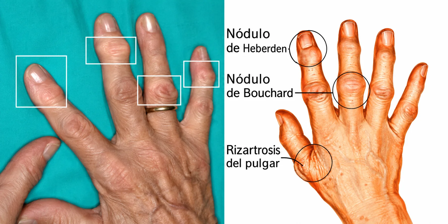 artrosis-manos-muneca-grup-policlinic